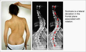 Scoliosis_Fig03_en