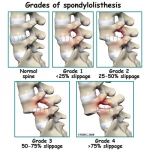 lumbar_spondylolisthesis_grades-300x300