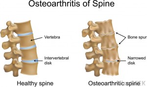 spondylosis