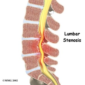 stenosis